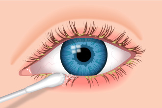 blepharitis