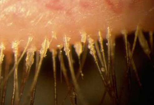 blepharitis