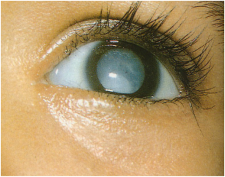 cataratta-congenita-1