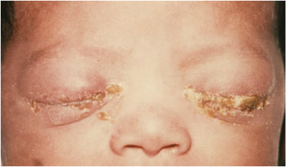 gonococcal-ophthalmia-neonatorum-1