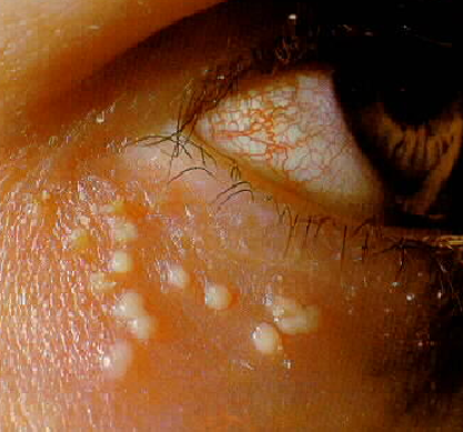 herpes_orig