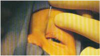 dacrio-intervento