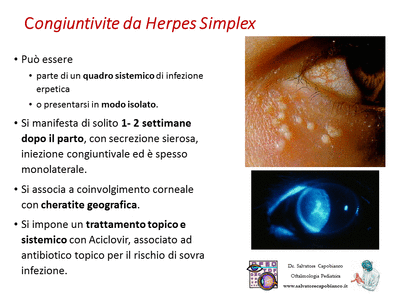 Retinopatia del prematuro (ROP) - Malattia vascolare della retina nei neonati pretermine