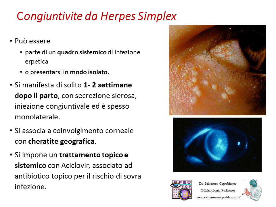 Retinopatia del prematuro (ROP) - Malattia vascolare della retina nei neonati pretermine