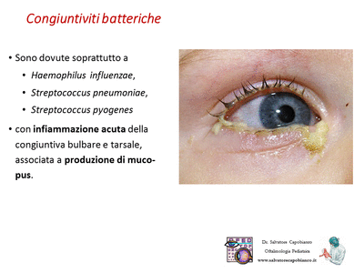 Retinopatia del prematuro (ROP) - Malattia vascolare della retina nei neonati pretermine