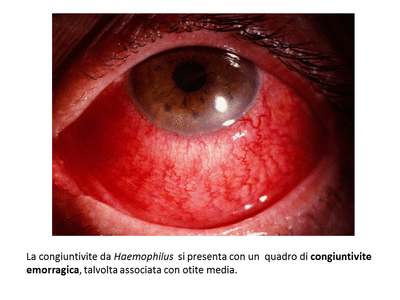 Retinopatia del prematuro (ROP) - Malattia vascolare della retina nei neonati pretermine
