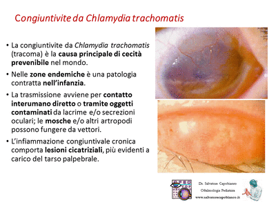 Retinopatia del prematuro (ROP) - Malattia vascolare della retina nei neonati pretermine