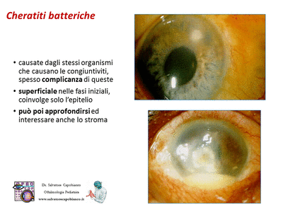 Retinopatia del prematuro (ROP) - Malattia vascolare della retina nei neonati pretermine