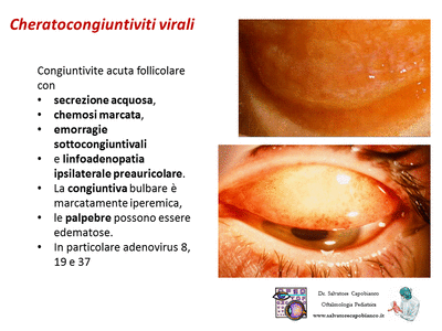 Retinopatia del prematuro (ROP) - Malattia vascolare della retina nei neonati pretermine