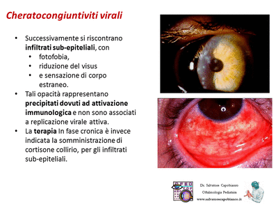 Retinopatia del prematuro (ROP) - Malattia vascolare della retina nei neonati pretermine