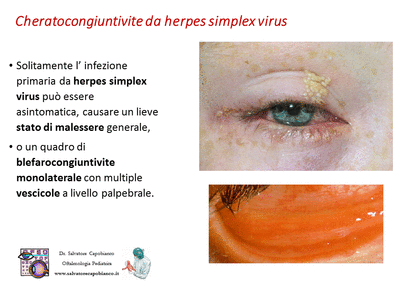 Retinopatia del prematuro (ROP) - Malattia vascolare della retina nei neonati pretermine