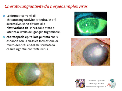 Retinopatia del prematuro (ROP) - Malattia vascolare della retina nei neonati pretermine