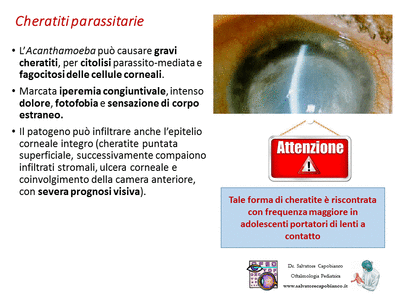 Retinopatia del prematuro (ROP) - Malattia vascolare della retina nei neonati pretermine
