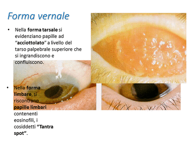 Retinopatia del prematuro (ROP) - Malattia vascolare della retina nei neonati pretermine