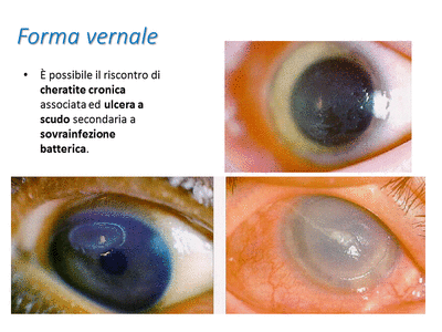 Retinopatia del prematuro (ROP) - Malattia vascolare della retina nei neonati pretermine