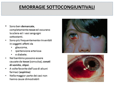 Retinopatia del prematuro (ROP) - Malattia vascolare della retina nei neonati pretermine