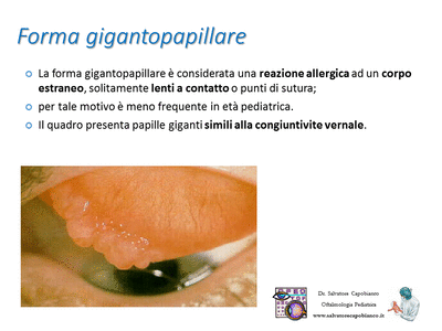 Retinopatia del prematuro (ROP) - Malattia vascolare della retina nei neonati pretermine