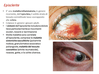 Retinopatia del prematuro (ROP) - Malattia vascolare della retina nei neonati pretermine