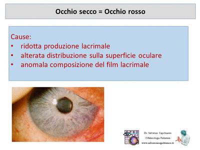 Retinopatia del prematuro (ROP) - Malattia vascolare della retina nei neonati pretermine