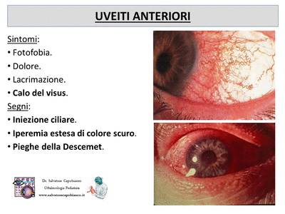 Retinopatia del prematuro (ROP) - Malattia vascolare della retina nei neonati pretermine
