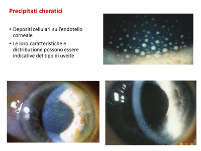 Retinopatia del prematuro (ROP) - Malattia vascolare della retina nei neonati pretermine