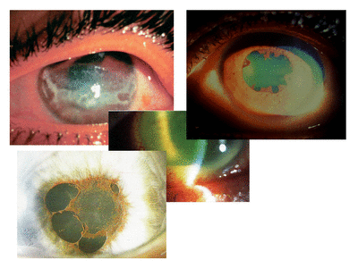 Retinopatia del prematuro (ROP) - Malattia vascolare della retina nei neonati pretermine