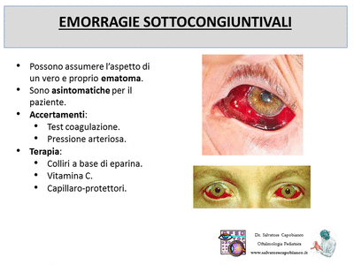 Retinopatia del prematuro (ROP) - Malattia vascolare della retina nei neonati pretermine