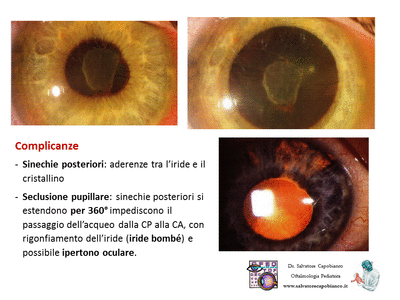 Retinopatia del prematuro (ROP) - Malattia vascolare della retina nei neonati pretermine