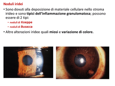 Retinopatia del prematuro (ROP) - Malattia vascolare della retina nei neonati pretermine