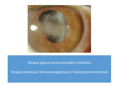 Retinopatia del prematuro (ROP) - Malattia vascolare della retina nei neonati pretermine