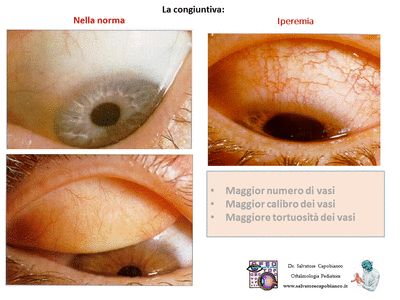 Retinopatia del prematuro (ROP) - Malattia vascolare della retina nei neonati pretermine
