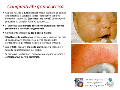 Retinopatia del prematuro (ROP) - Malattia vascolare della retina nei neonati pretermine