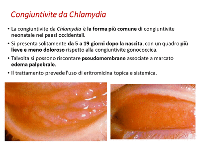 Retinopatia del prematuro (ROP) - Malattia vascolare della retina nei neonati pretermine