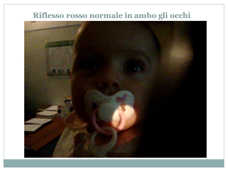 Controllo oculistico bambino - Diagnosi precoce patologie