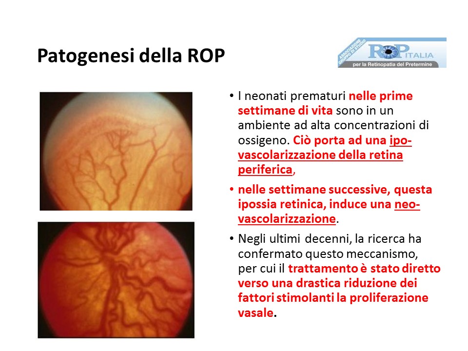 Retinopatia del prematuro (ROP) - Malattia vascolare della retina nei neonati pretermine