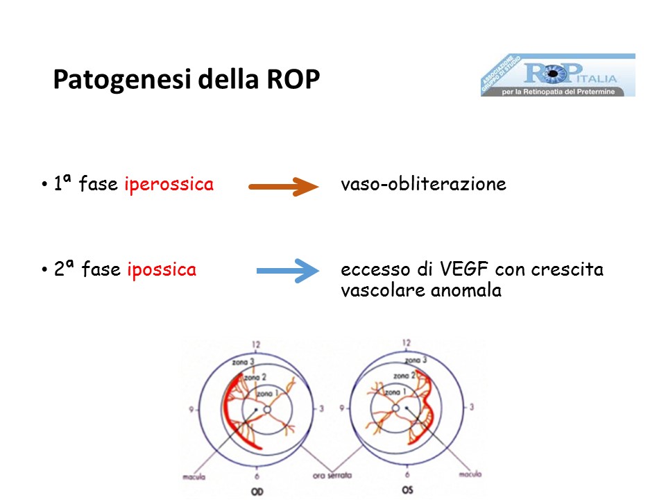 Retinopatia del prematuro (ROP) - Malattia vascolare della retina nei neonati pretermine