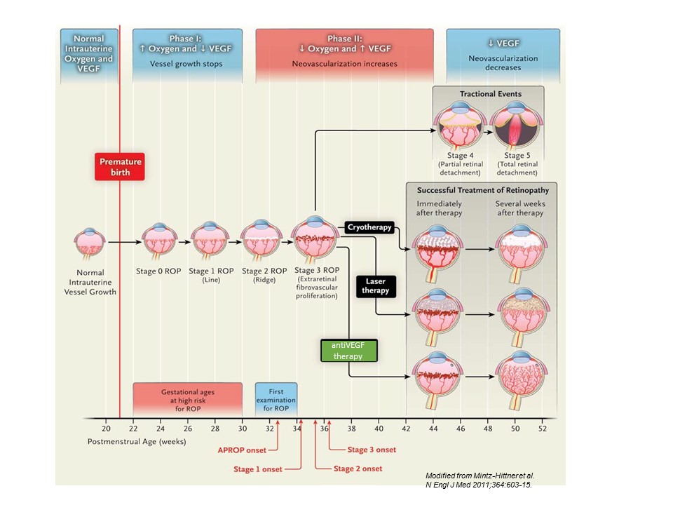 Retinopatia del prematuro (ROP) - Malattia vascolare della retina nei neonati pretermine
