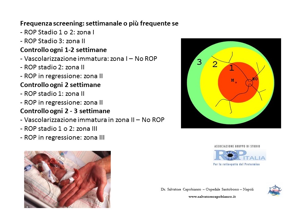 Retinopatia del prematuro (ROP) - Malattia vascolare della retina nei neonati pretermine
