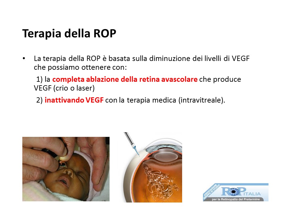 Retinopatia del prematuro (ROP) - Malattia vascolare della retina nei neonati pretermine