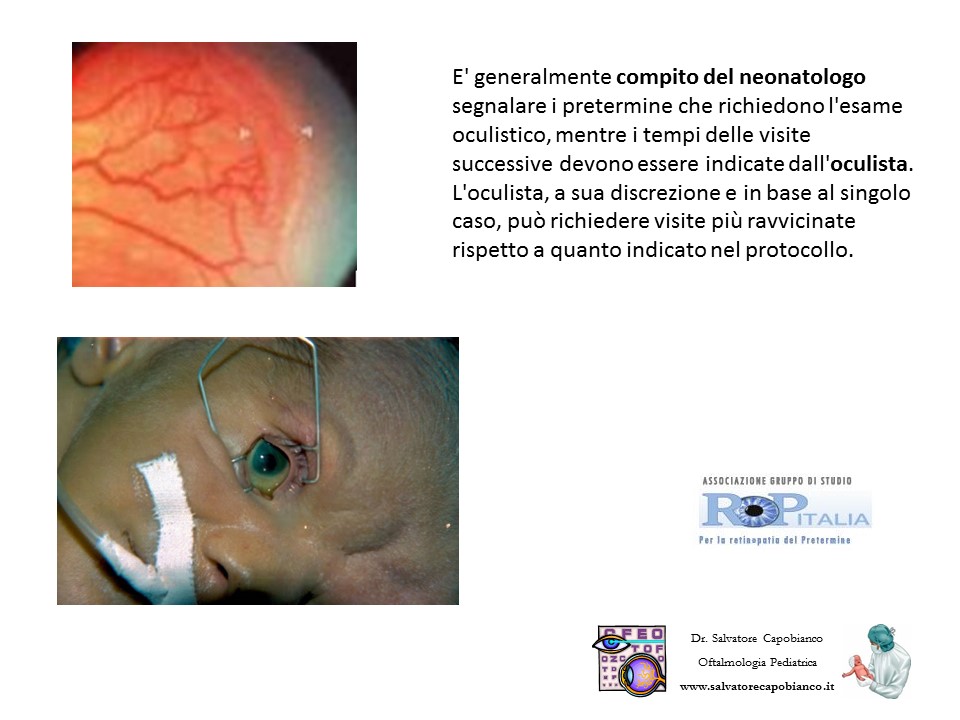 Retinopatia del prematuro (ROP) - Malattia vascolare della retina nei neonati pretermine