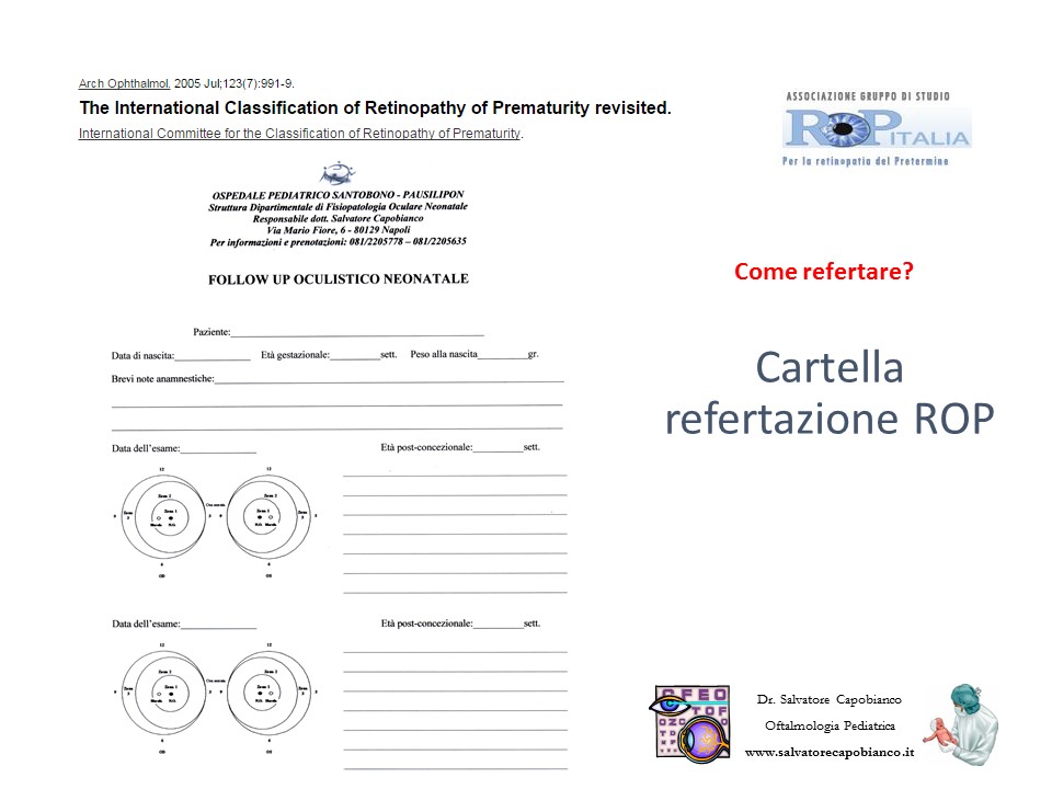 Retinopatia del prematuro (ROP) - Malattia vascolare della retina nei neonati pretermine