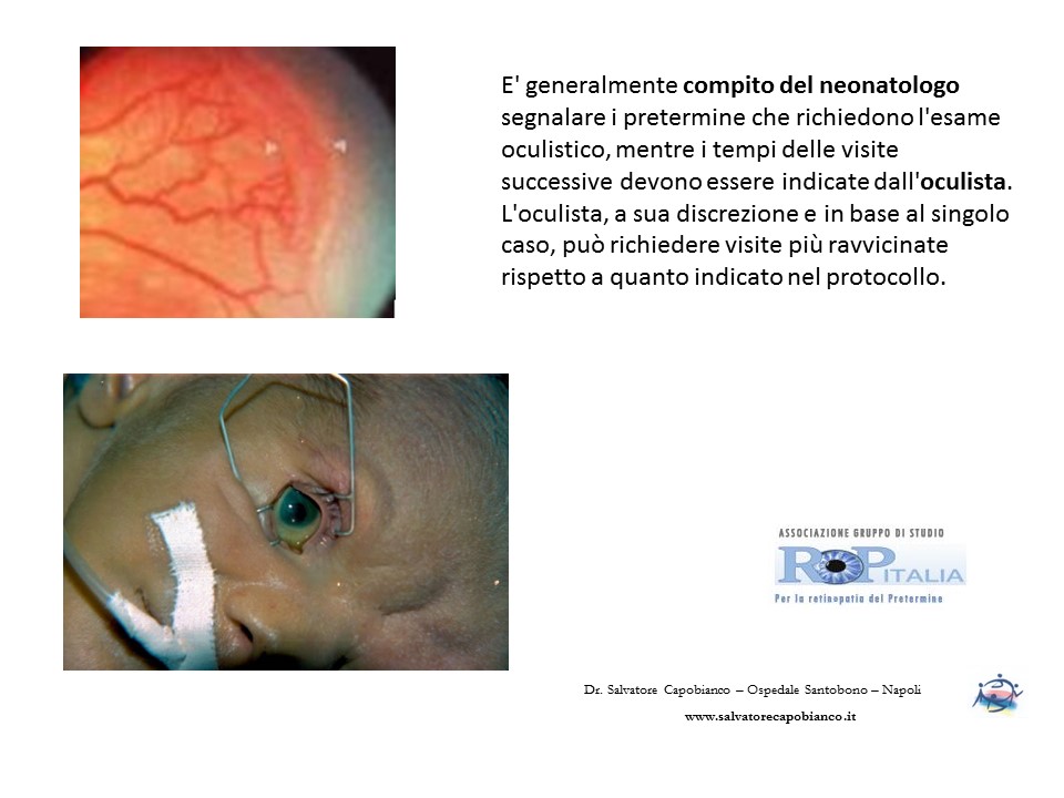 Retinopatia del prematuro (ROP) - Malattia vascolare della retina nei neonati pretermine