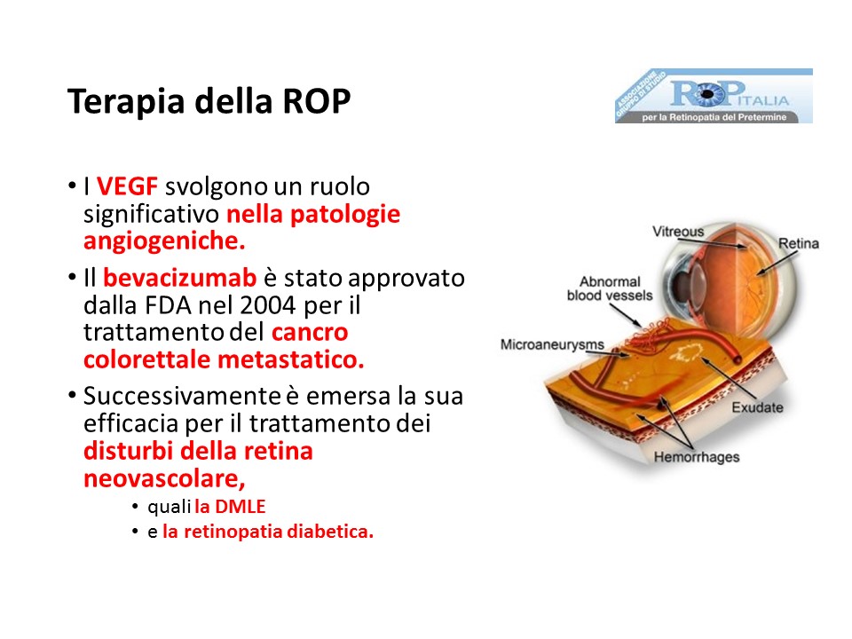 Retinopatia del prematuro (ROP) - Malattia vascolare della retina nei neonati pretermine