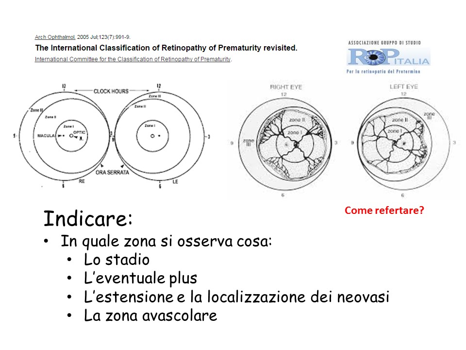 Retinopatia del prematuro (ROP) - Malattia vascolare della retina nei neonati pretermine