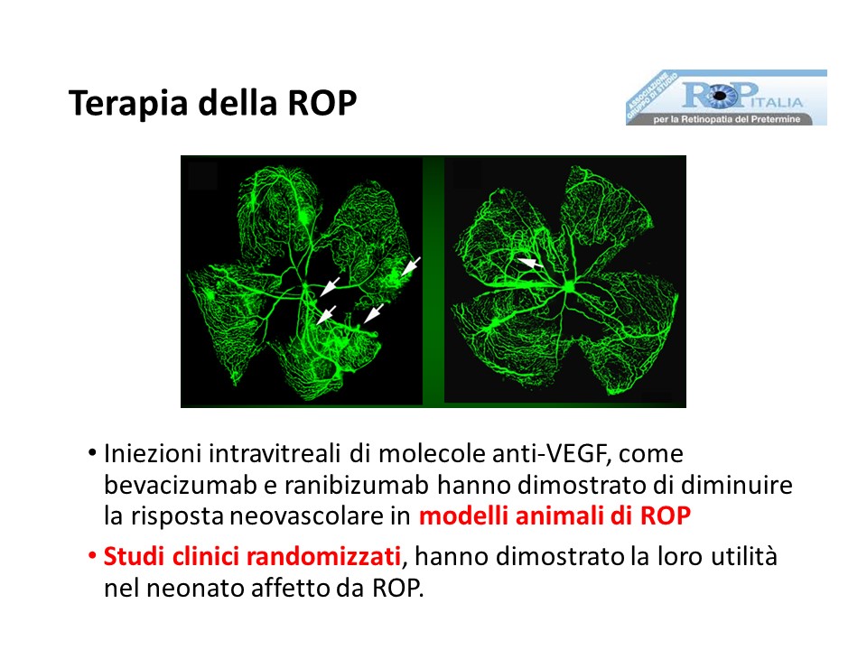 Retinopatia del prematuro (ROP) - Malattia vascolare della retina nei neonati pretermine