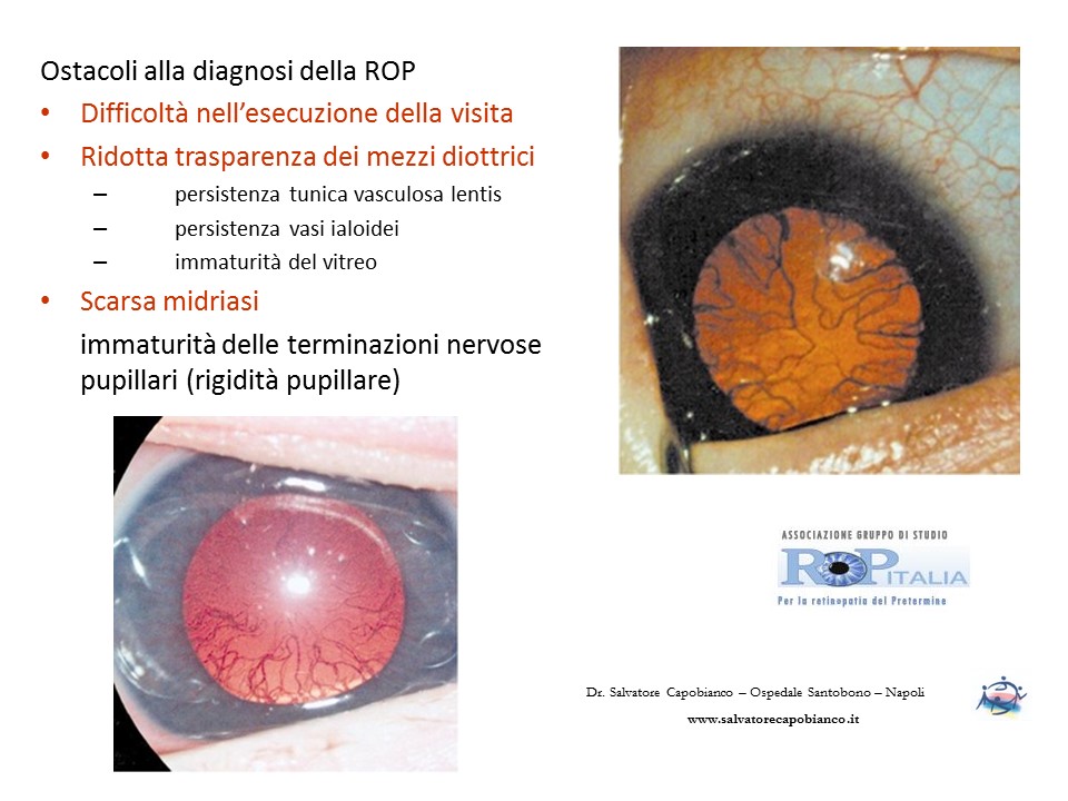 Retinopatia del prematuro (ROP) - Malattia vascolare della retina nei neonati pretermine