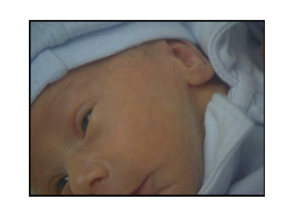Retinopatia del prematuro (ROP) - Malattia vascolare della retina nei neonati pretermine