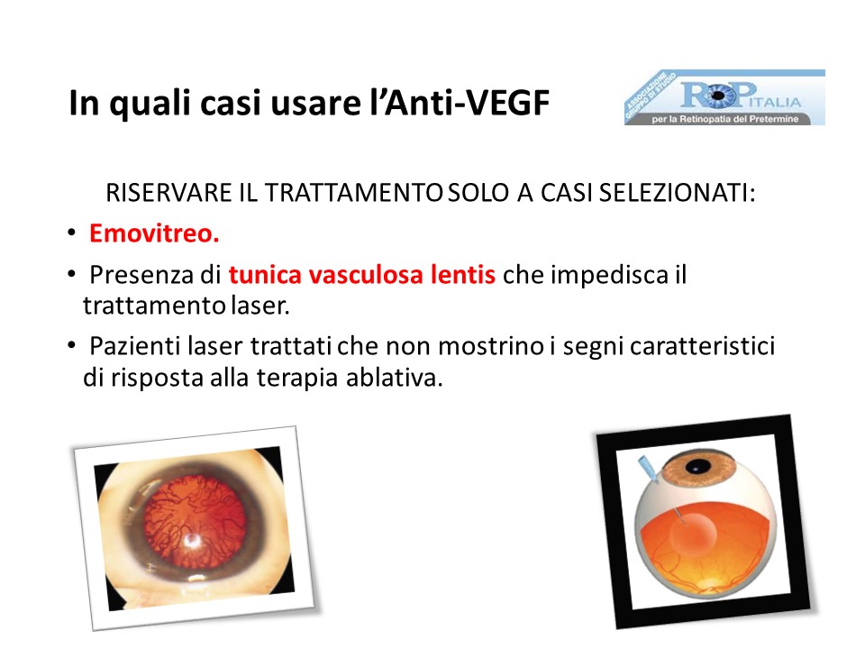 Retinopatia del prematuro (ROP) - Malattia vascolare della retina nei neonati pretermine