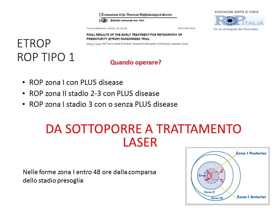 Retinopatia del prematuro (ROP) - Malattia vascolare della retina nei neonati pretermine
