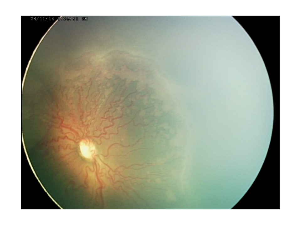 Retinopatia del prematuro (ROP) - Malattia vascolare della retina nei neonati pretermine